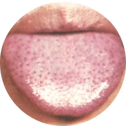 舌上有红点或芒刺,则内热过盛 舌上有红点或芒刺,则内热过盛