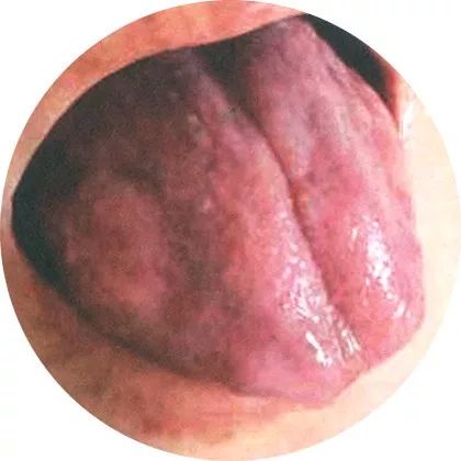 舌色红绛而舌体干燥,有芒刺或裂纹,为内热炽盛; 舌色红绛而舌体干燥,有芒刺或裂纹,为内热炽盛;