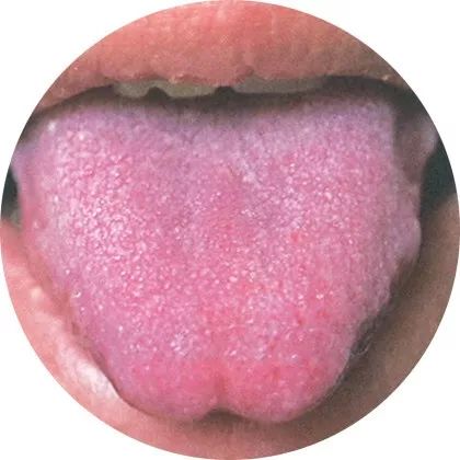 寒证、热证,或者瘀血证都可能会出现这种舌象,主要由血液运行不畅引起的 寒证、热证,或者瘀血证都可能会出现这种舌象,主要由血液运行不畅引起的