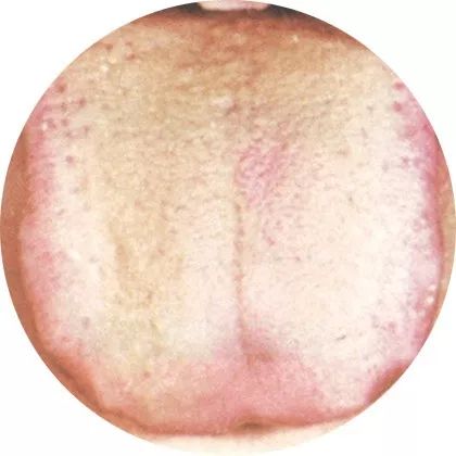 胖淡舌:阳气虚弱 胖淡舌:阳气虚弱