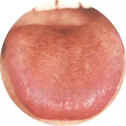 瘦红舌:缺乏营养 瘦红舌:缺乏营养