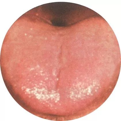 嫩舌:代谢功能低下 嫩舌:代谢功能低下