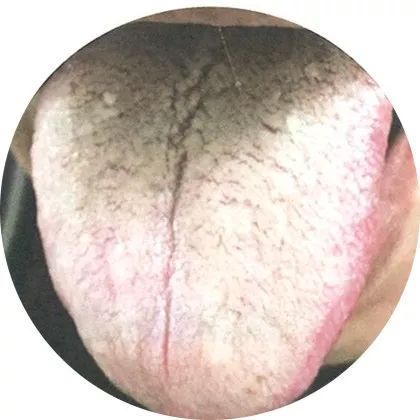 厚苔:肠胃积滞 厚苔:肠胃积滞