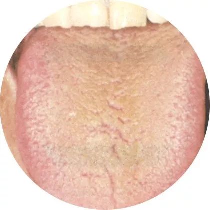 燥苔:吐泻伤津 燥苔:吐泻伤津