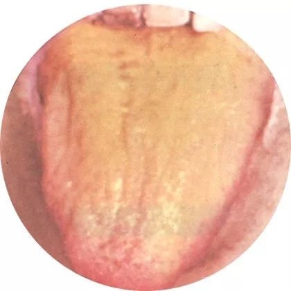 黄苔:由寒化热 黄苔:由寒化热