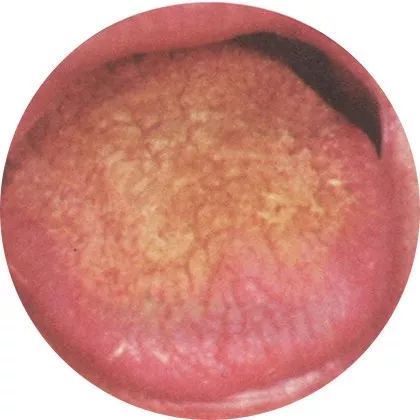 糙苔:津液亏损 糙苔:津液亏损