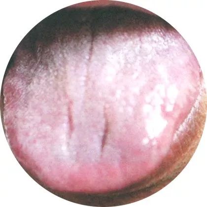 腻苔:湿浊蕴结 腻苔:湿浊蕴结