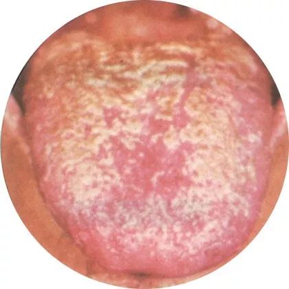 腐苔:内热过旺 腐苔:内热过旺