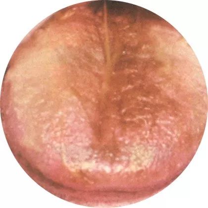 灰苔:湿浊困阻 灰苔:湿浊困阻