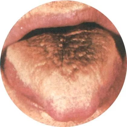 黑苔:邪热加重 黑苔:邪热加重