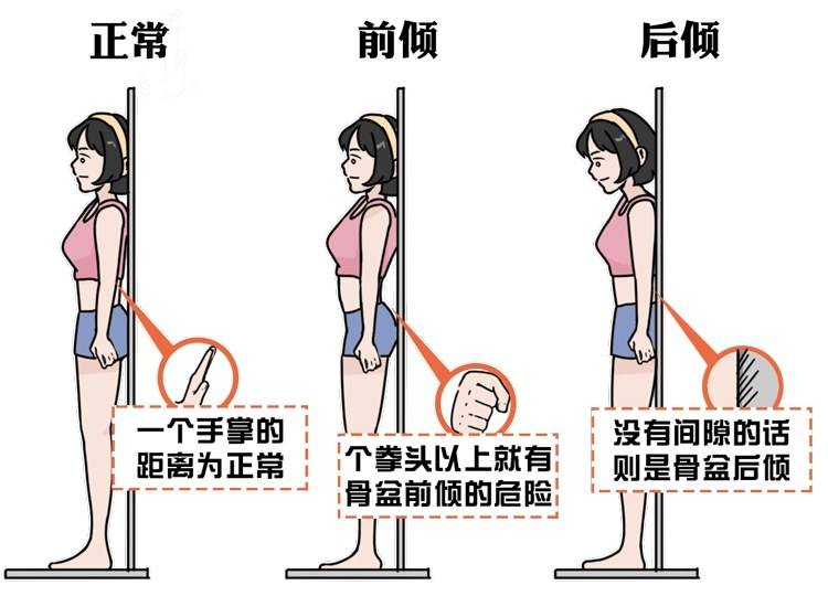 骨盆后倾和前倾的区别! 骨盆后倾和前倾的区别!