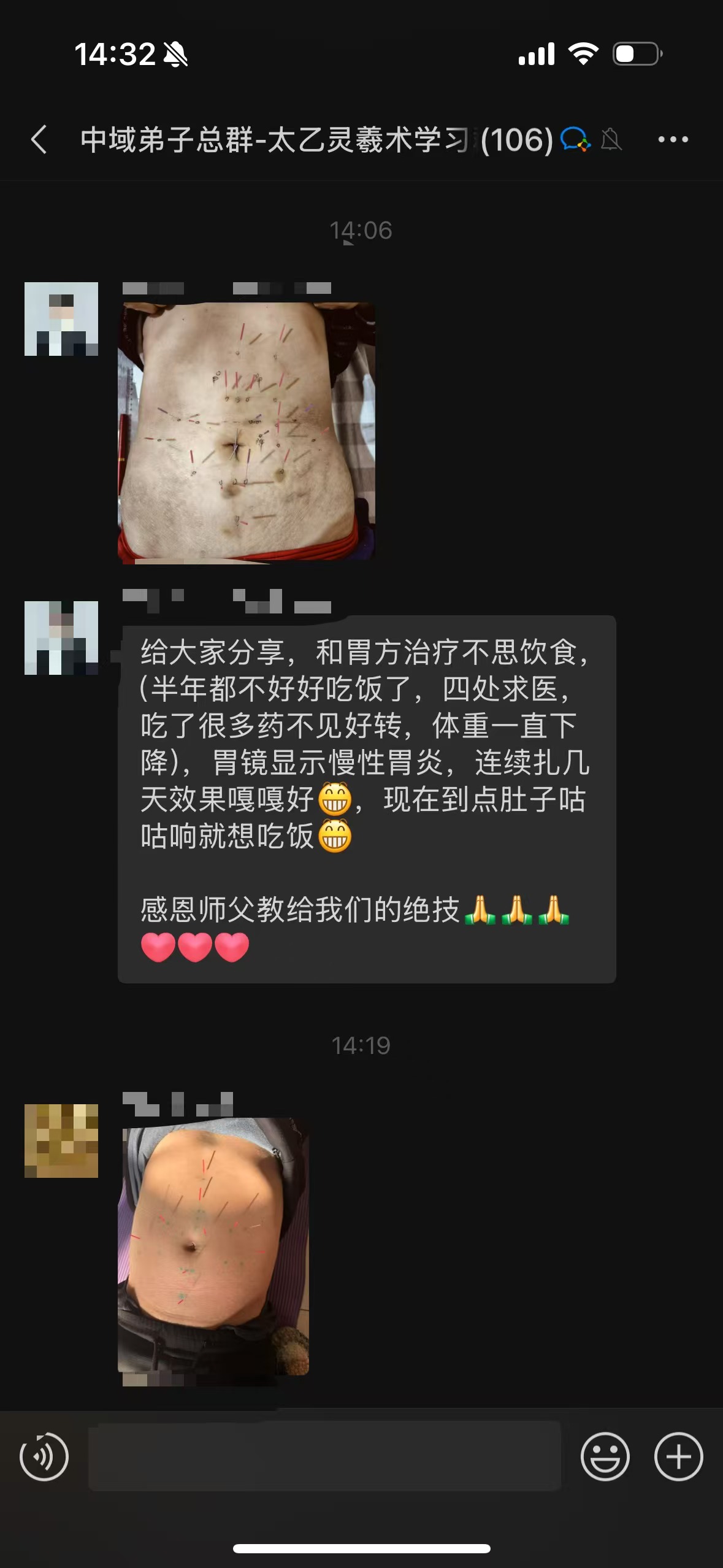太乙灵羲术弟子反馈：无痛针灸调理不思饮食，现在到点就想吃饭！