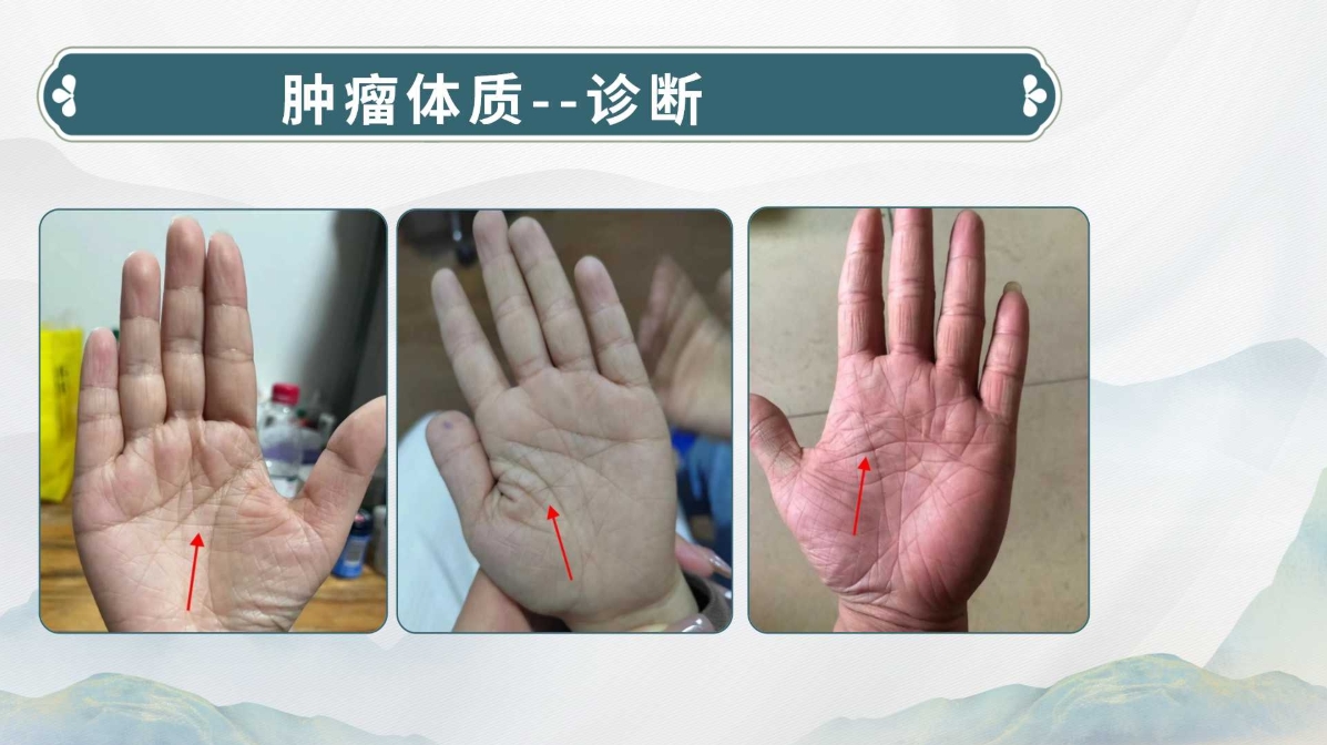 生命全息手诊——肿瘤体质诊断方法(附调理方案)! 生命全息手诊——肿瘤体质诊断方法(附调理方案)!