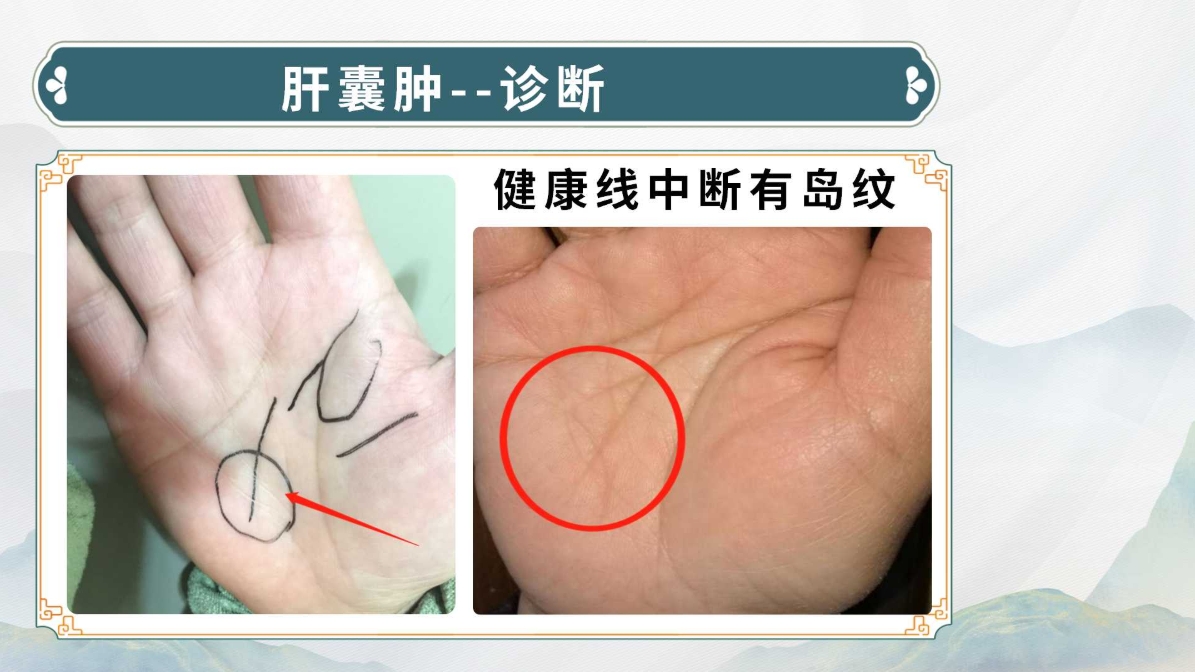 生命全息手诊——肝囊肿诊断方法(附调理方案)! 生命全息手诊——肝囊肿诊断方法(附调理方案)!