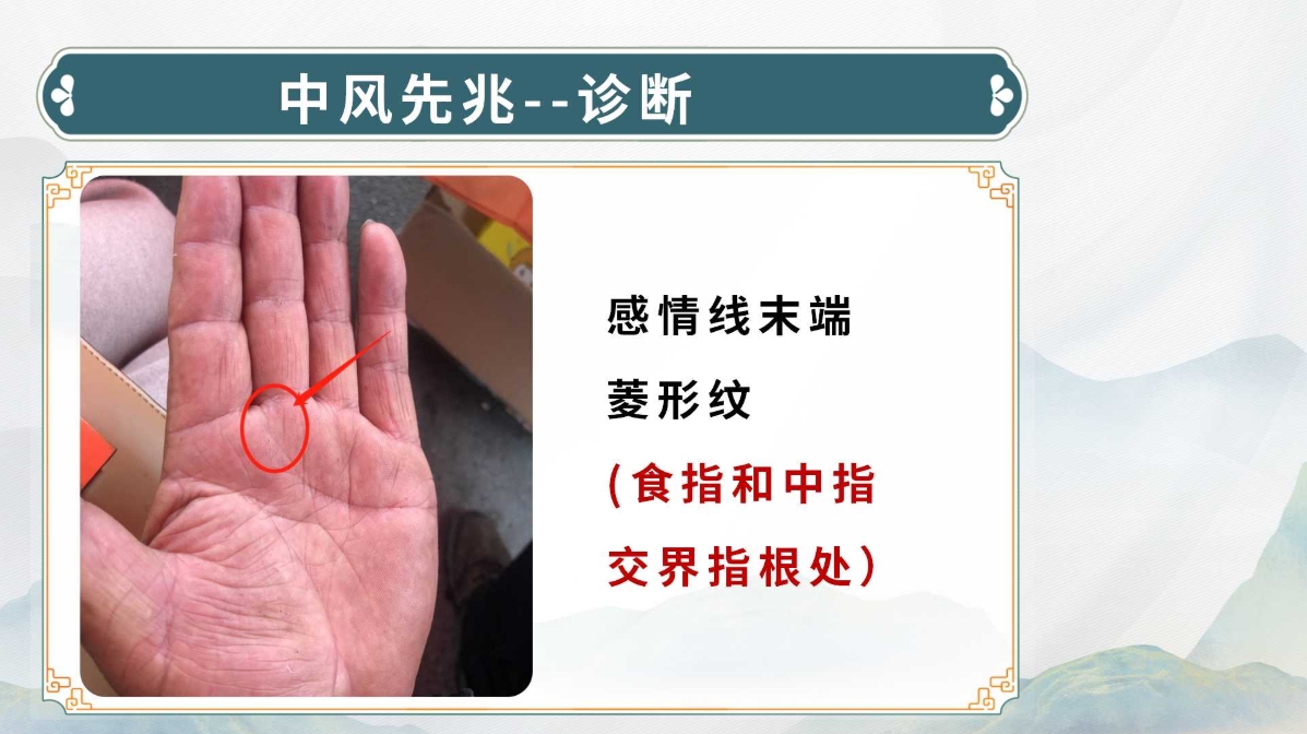 生命全息手诊——中风诊断方法(附调理方案)! 生命全息手诊——中风诊断方法(附调理方案)!