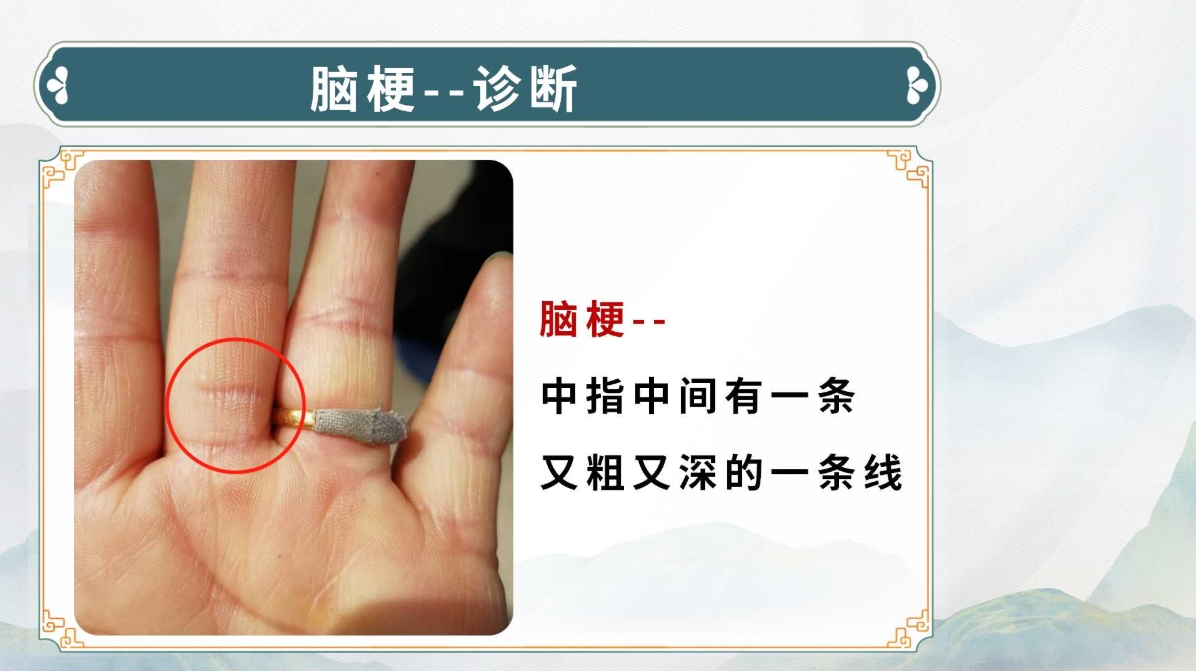 生命全息手诊——脑梗诊断方法（附调理方案）！