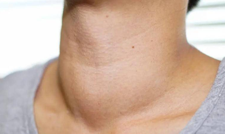 正元堂结减:发现脖子上有结节不要慌!看看这篇文章! - 知乎