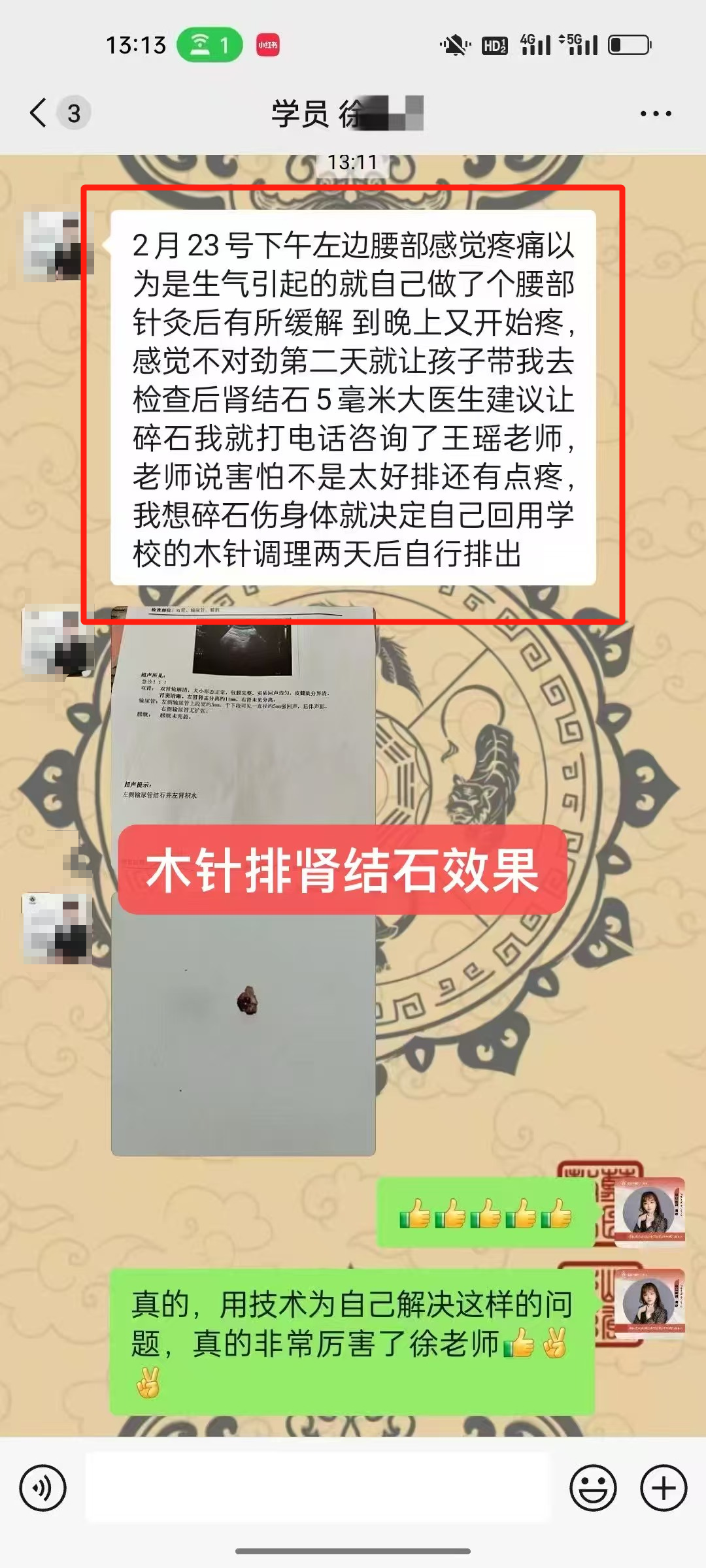 木针疗法好评反馈：5毫米肾结石通过木针调理后，自行排出！