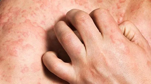 痒痛魔咒破解! 痒痛魔咒破解!