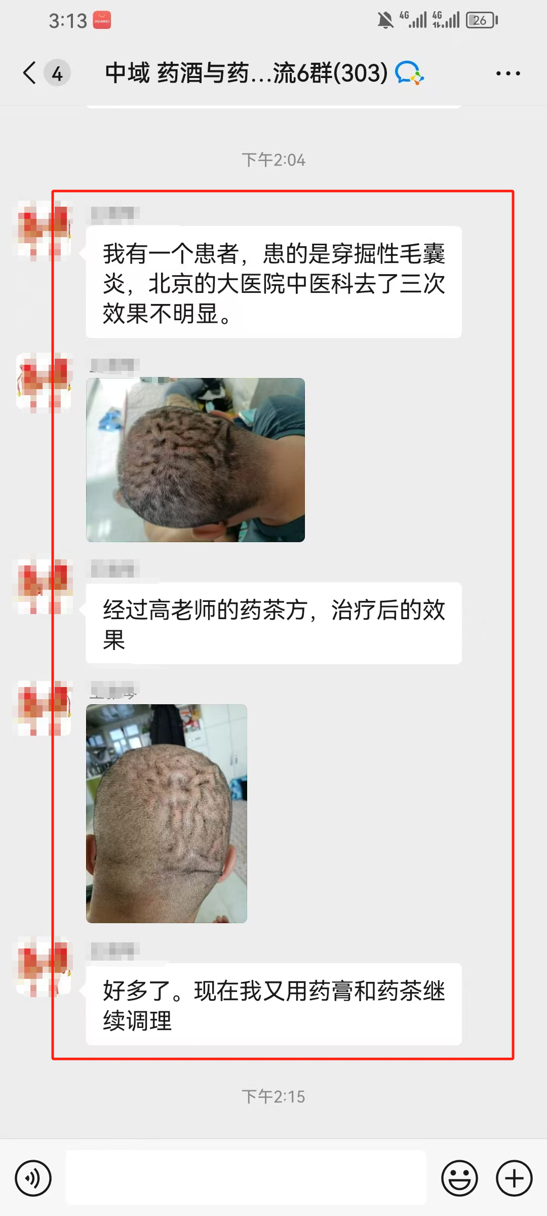 药酒与药茶学员反馈：穿掘性毛囊炎患者，用高老师的药茶方调理好多了！