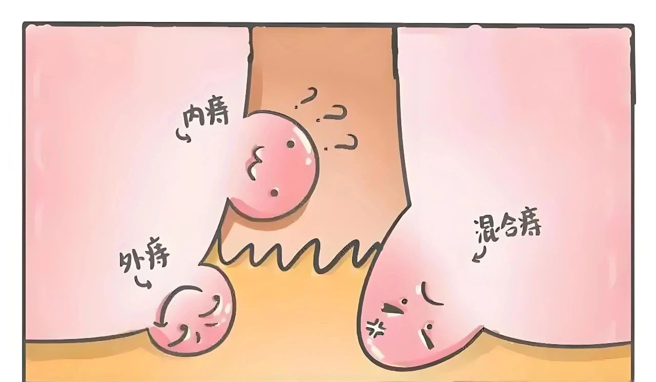 根除痔疮蕞好的办法,竟然是…… 根除痔疮蕞好的办法,竟然是……