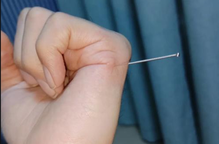 针灸入门自学指南：理论是基础，实践是核心！