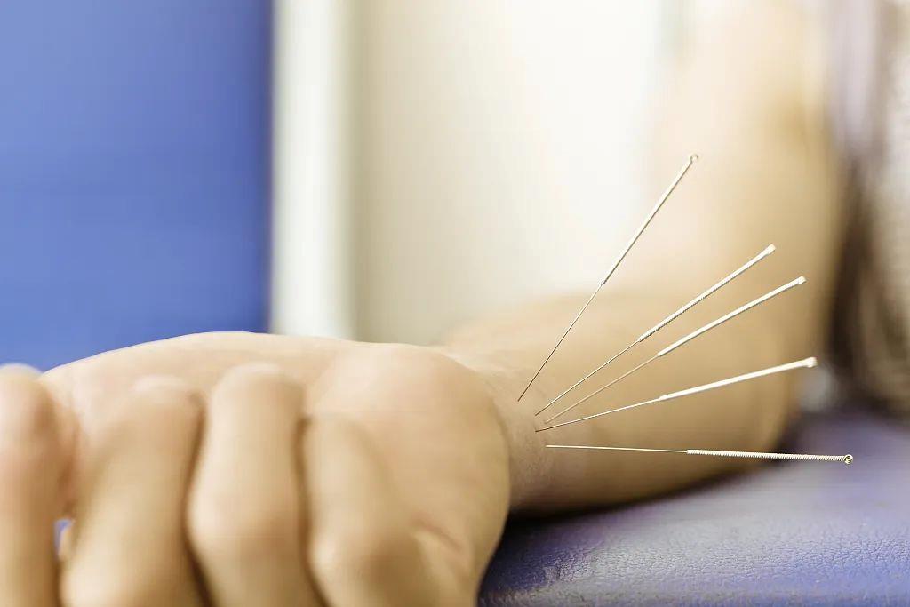 针灸能治什么病?详解其作用与功效 针灸能治什么病?详解其作用与功效