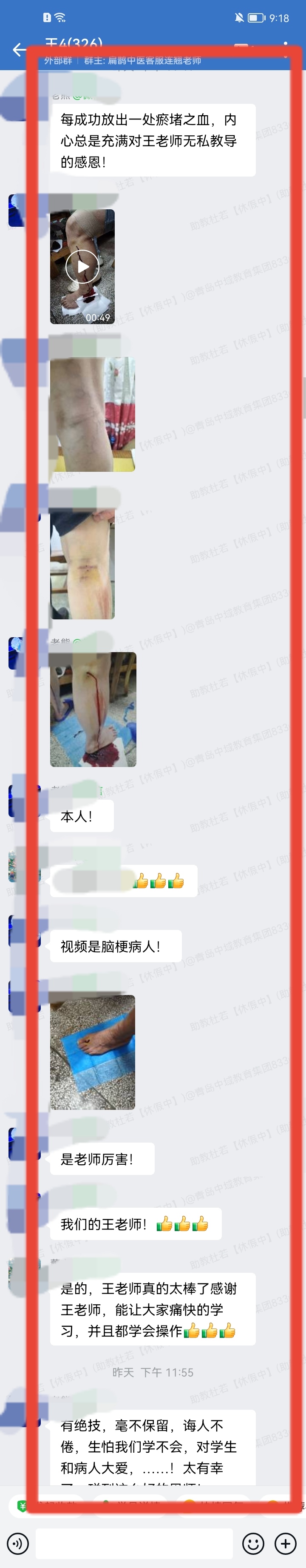 王氏刺血排瘀疗法学员反馈：为脑梗后遗症患者刺血排瘀，感恩王老师！