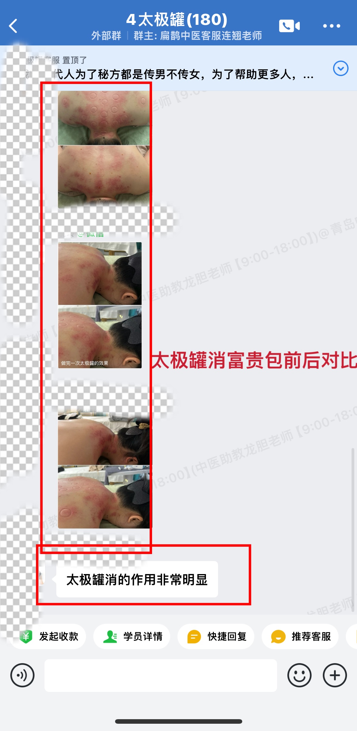 陈实功太极罐学员反馈：美容针扎好了眼睛问题和舌尖麻问题，太极罐消富贵包非常明显！